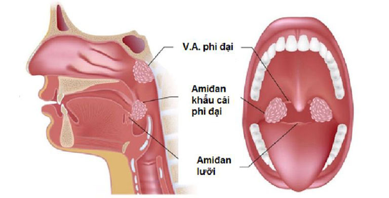 Viêm amidan lưỡi là gì?