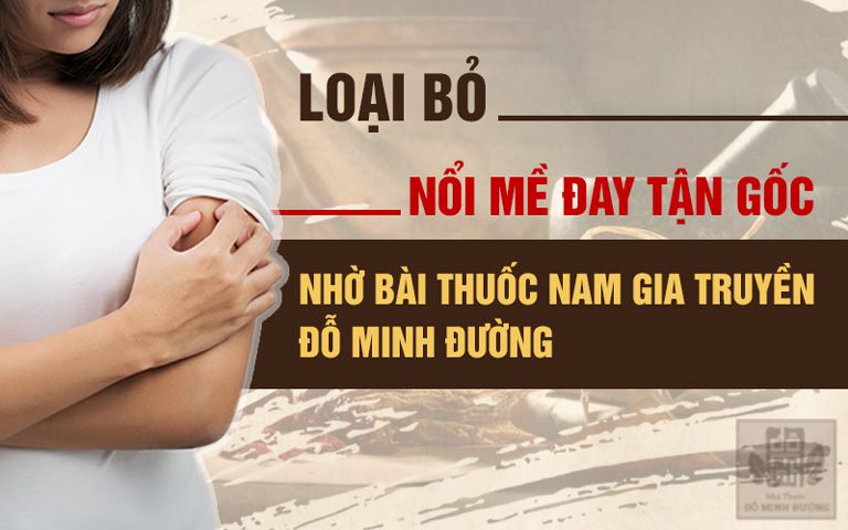 Bài thuốc chữa nổi mề đay cấp và mãn tính của Đỗ Minh Đường hiệu quả dứt điểm