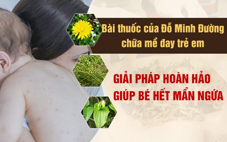 Bài thuốc chữa nổi mề đay ở trẻ em,hiệu quả của Đỗ Minh Đường