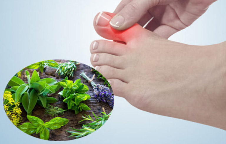 Trị bệnh gout cấp tính bằng Đông y