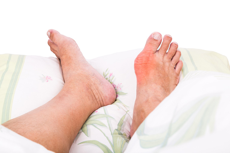 Dấu hiệu nhận biết bệnh gout cấp tính