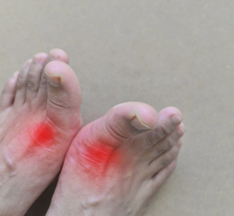 Bệnh gout có chữa khỏi được không?