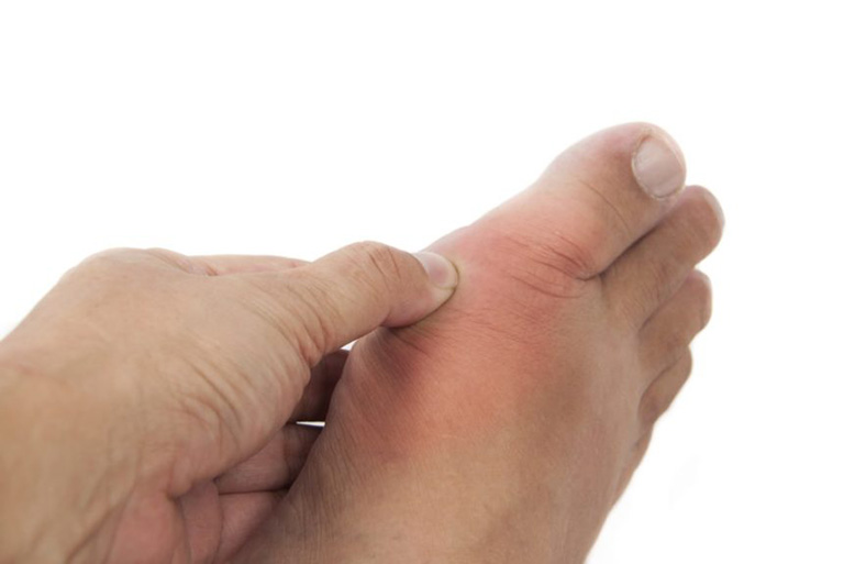 Bệnh gout có lây nhiễm hay di truyền không?