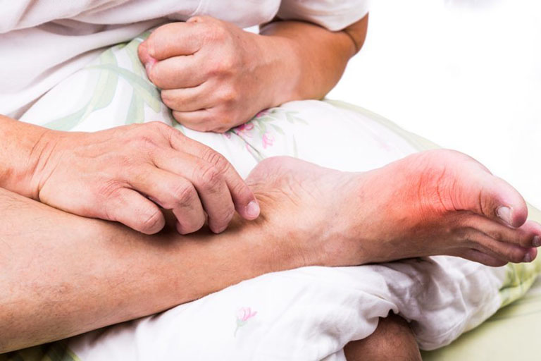 Bệnh gout có lây nhiễm hay di truyền không?