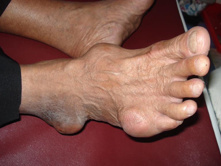 Bệnh gout có lây nhiễm hay di truyền không?