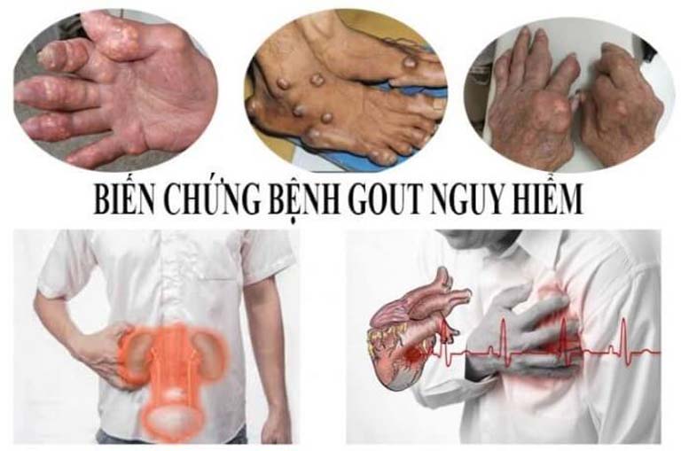 Bệnh gout mạn tính có nguy hiểm không?