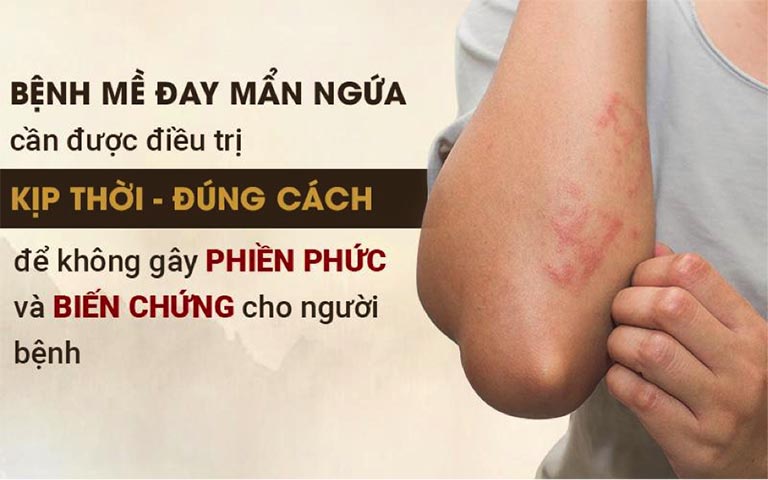 Bệnh Mề đay ở trẻ em cần được điều trị