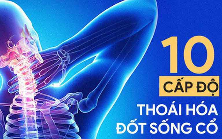 Thoái hóa đốt sống cổ