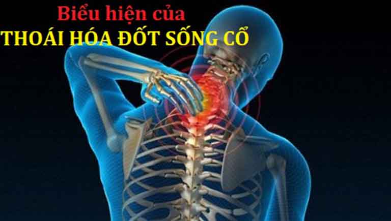 Thoái hóa đốt sống cổ