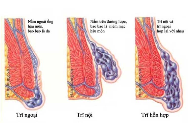 Dấu hiệu khi bị trĩ