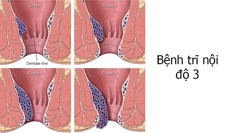 bệnh trĩ nội độ 3 có nguy hiểm không