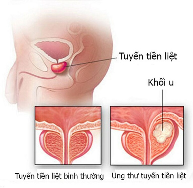 Các chế phẩm từ đậu nành (trong đó có đậu phụ) giúp nam giới phòng và chữa ung thư tuyến tiền liệt