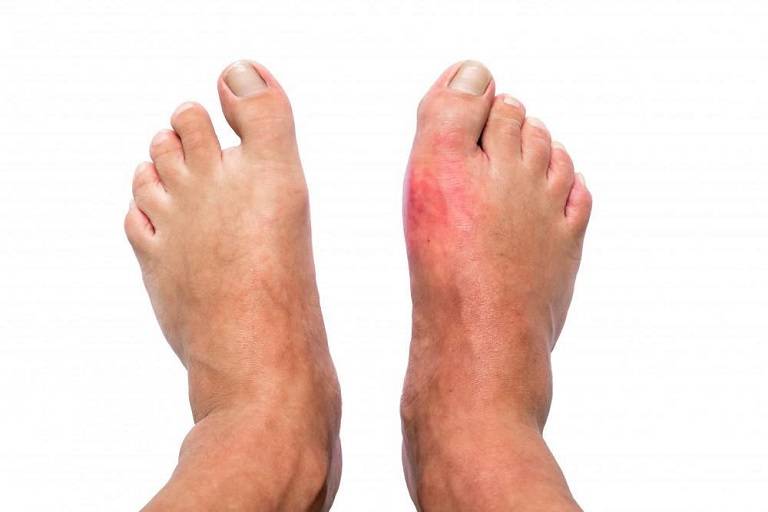 Bị bệnh gout có nên uống rượu bia không