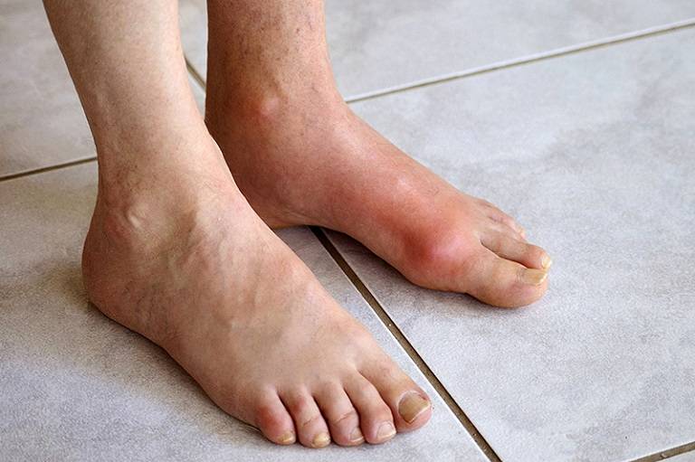 Bị bệnh gout uống nước đậu đen có được không