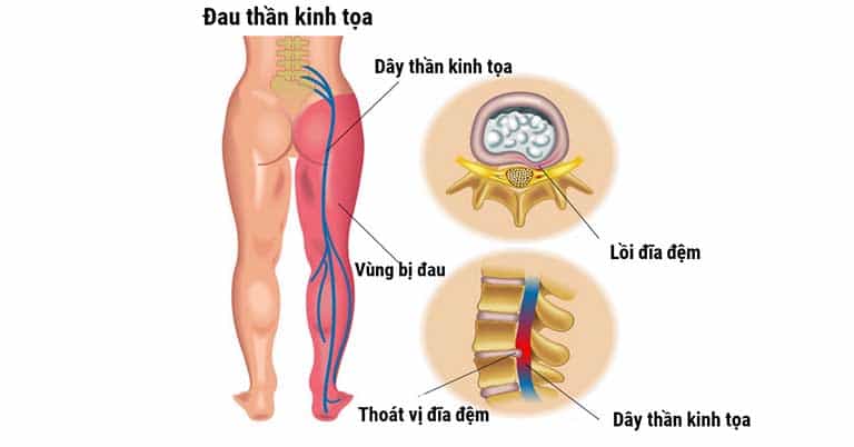 Bị đau thần kinh tọa có nên tập yoga