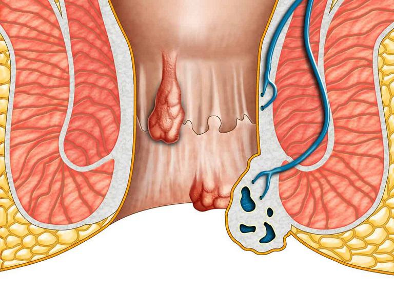 Chữa bệnh trĩ đơn giản chỉ với nắm lá tía tô