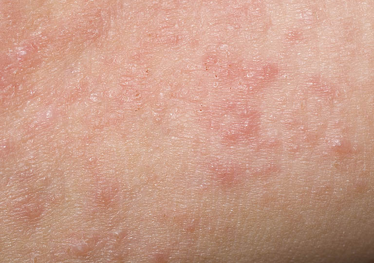Bị viêm da tiếp xúc bao lâu thì khỏi Bị viêm da tiếp xúc bao lâu thì khỏi