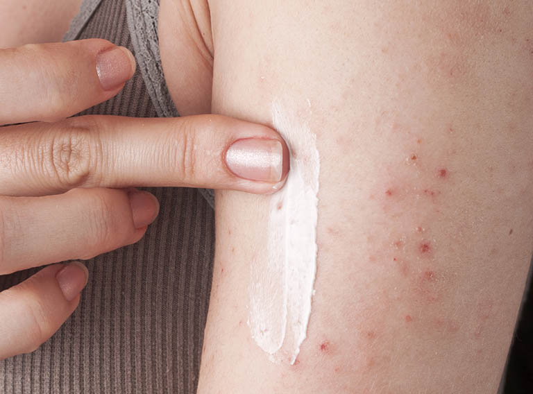 Bị viêm da tiếp xúc bao lâu thì khỏi Bị viêm da tiếp xúc bao lâu thì khỏi