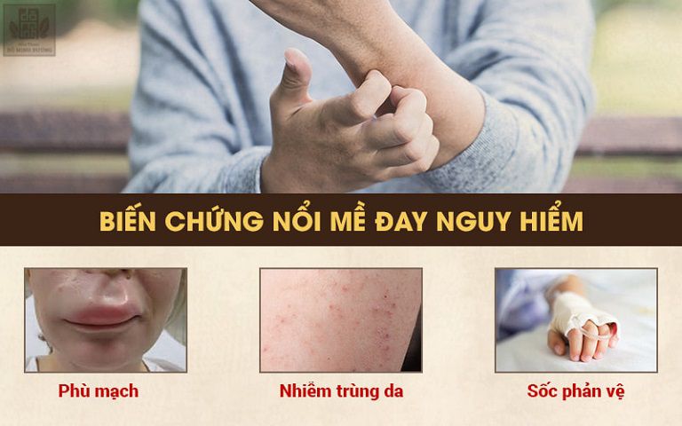 Biến chứng nguy hiểm của bệnh nổi mề đay