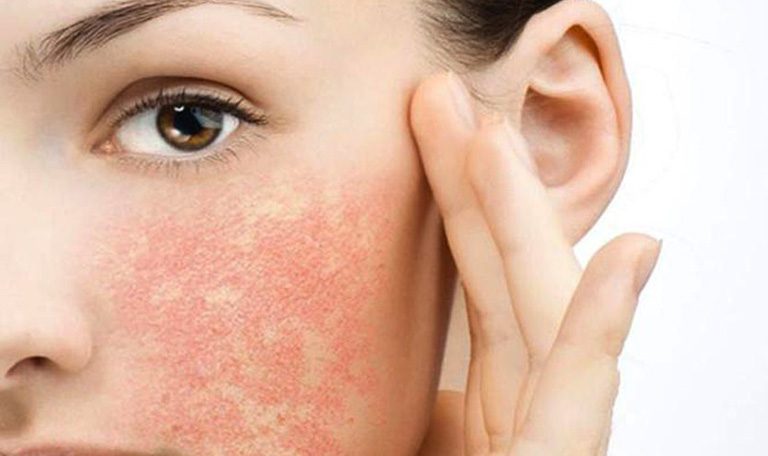 Dị ứng mỹ phẩm là nguyên nhân dẫn đến tình trạng da mặt bị nổi mẩn đỏ không ngứa