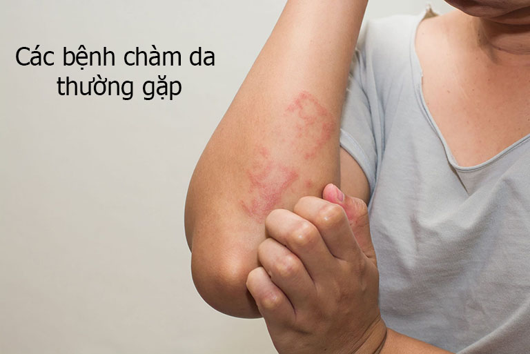 Các bệnh chàm da