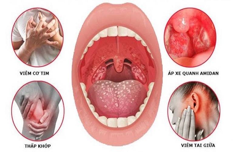 các biến chứng do viêm amidan