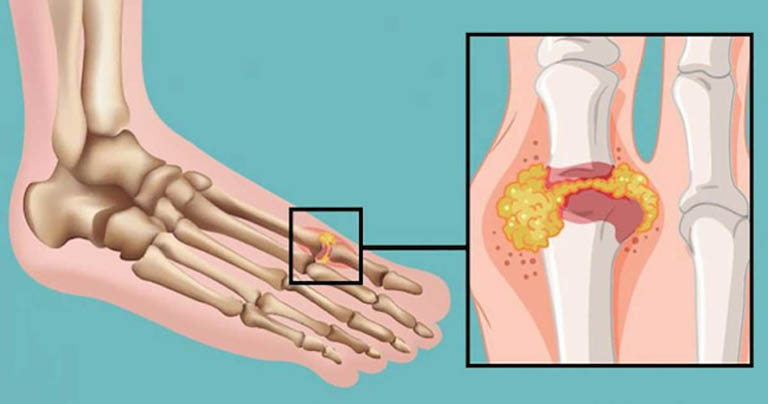 Các giai đoạn của bệnh gout và cách nhận biết