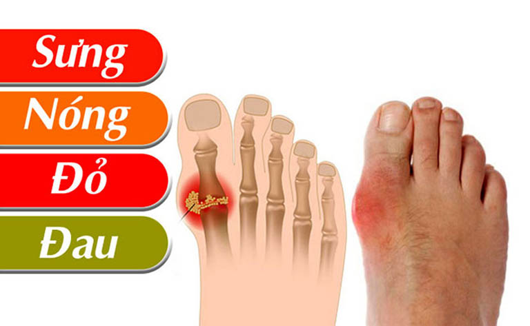 Các giai đoạn của bệnh gout và cách nhận biết