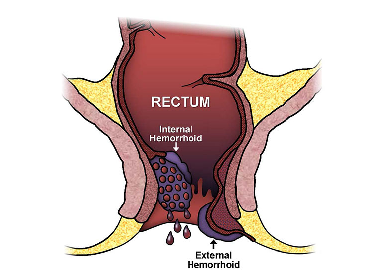 thuốc chữa bệnh trĩ nặng