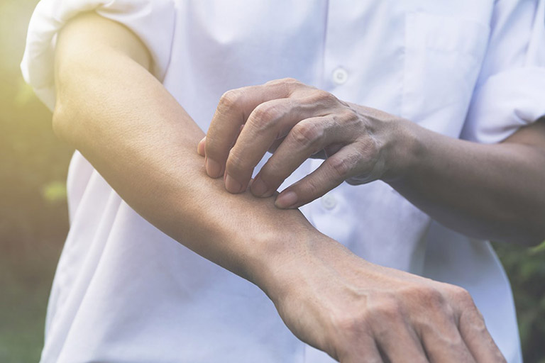 cách chữa dị ứng nổi mề đay tại nhà
