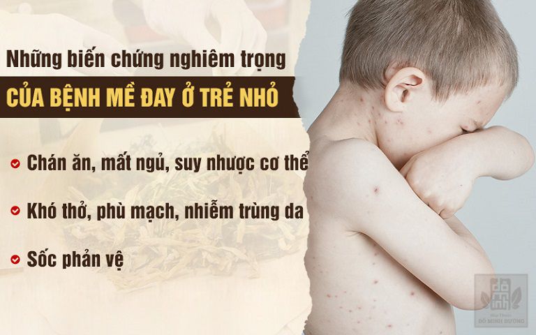 Biến chứng nguy hiểm của nổi mề đay ở trẻ em