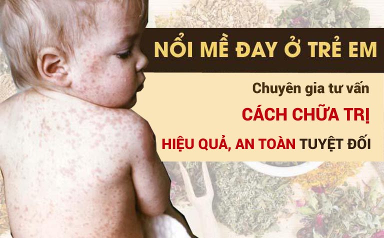 Chuyên gia Đông y tư vấn cách chữa nổi mề đay ở trẻ em hiệu quả