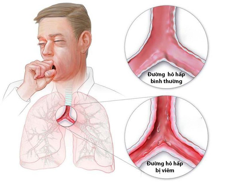 Bệnh trào ngược dạ dày có nguy hiểm không