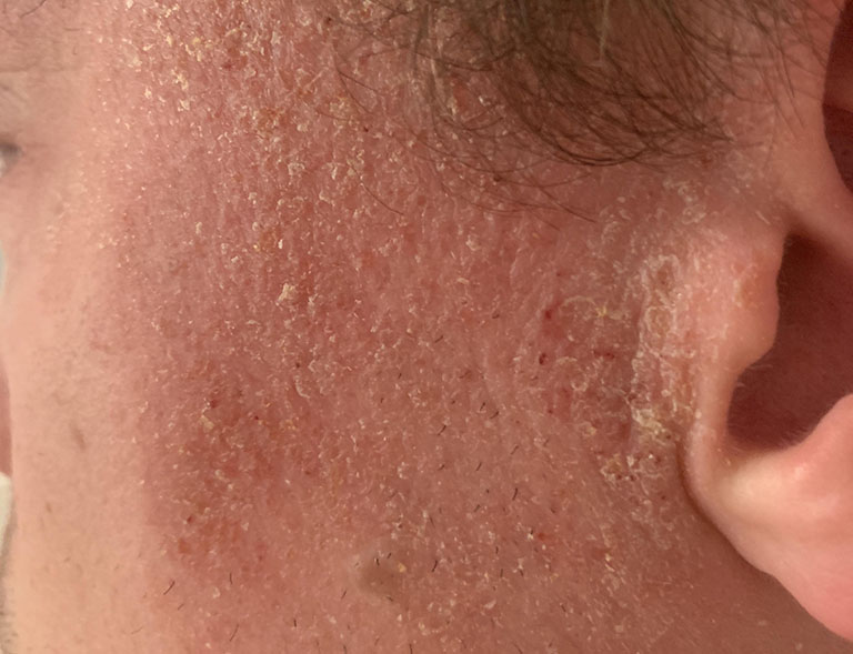 bệnh eczema ở mặt