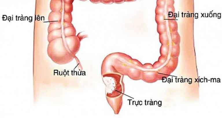 Đại tràng Sigma và những bệnh nguy hiểm thường gặp