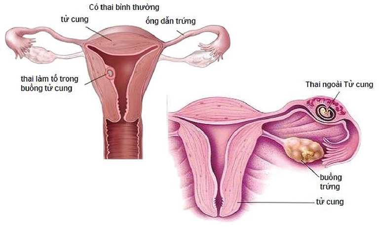 đau bụng dưới âm ỉ kéo dài ở nữ