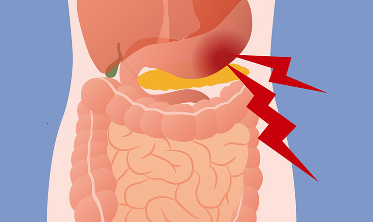 đau dạ dày có lan ra sau lưng