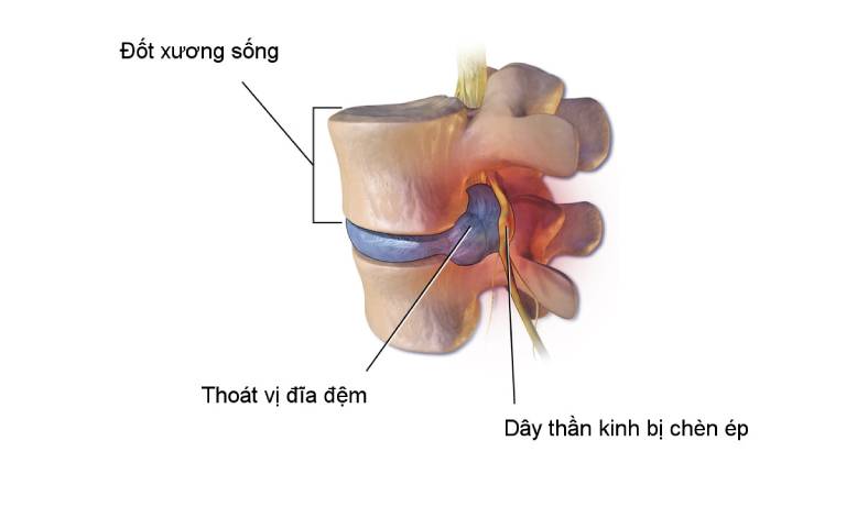 Thoái hóa đĩa đệm cổ khiến các day thần kinh bị chèn ép gây đau vai gáy, chóng mặt, buồn nôn
