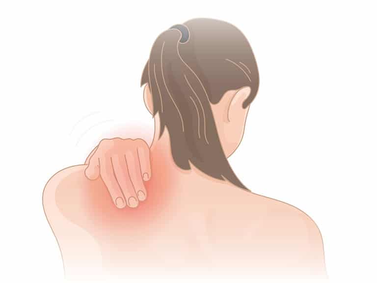 đau vai gáy ở phụ nữ sau khi sinh mổ