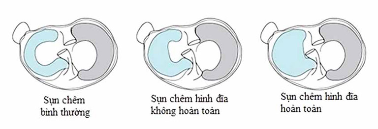 Đau đầu gối khi đứng lên ngồi xuống