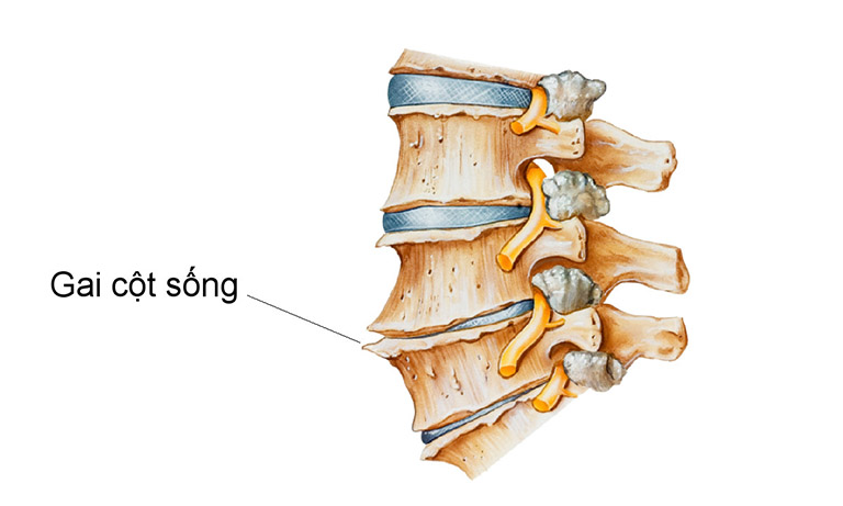 Bệnh gai cột sống là gì?