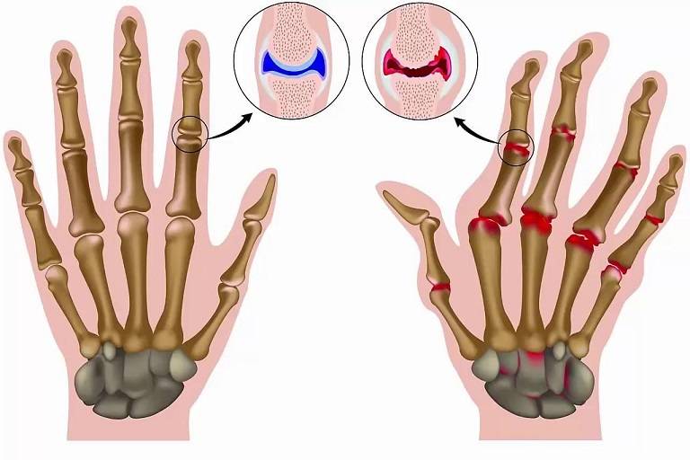 Hình ảnh X quang cảnh báo viêm khớp dạng thấp