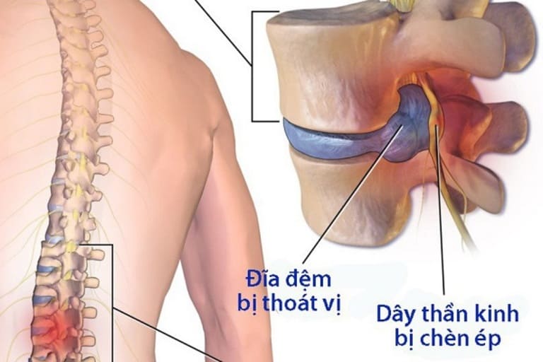 Thoát vị đĩa đệm cột sống thắt lưng