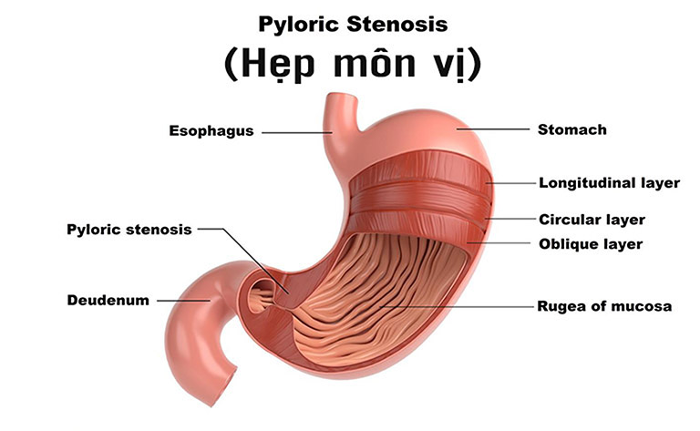 Hẹp môn vị ở trẻ