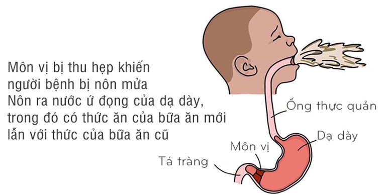 Hẹp môn vị ở trẻ