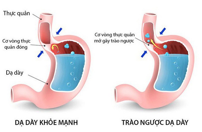 chữa trào ngược dạ dày bằng lá tía tô