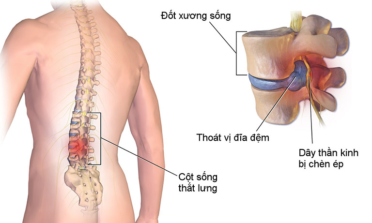 Có nên mổ thoát vị đĩa đệm không?