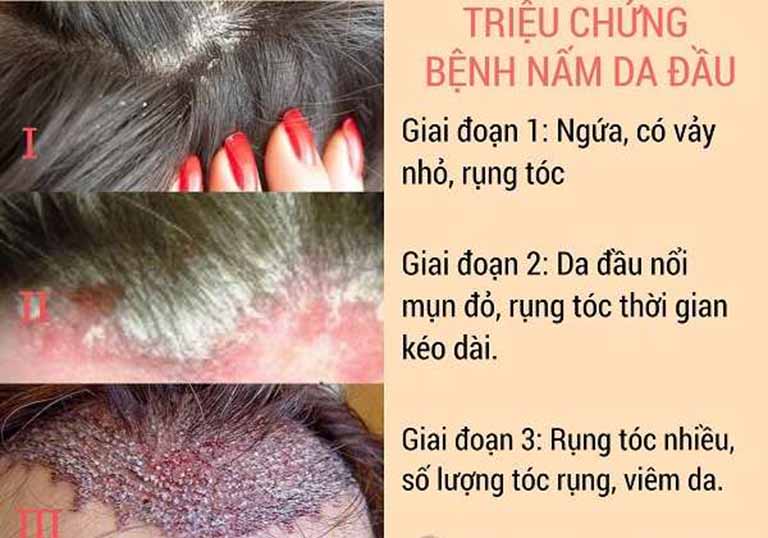 Nấm da đầu