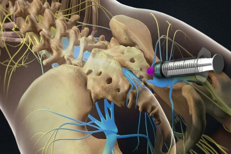 thủy châm chữa thoát vị đĩa đệm