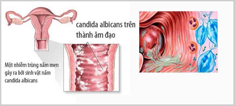 Nhiễm nấm candida khi mang thai có nguy hiểm không?